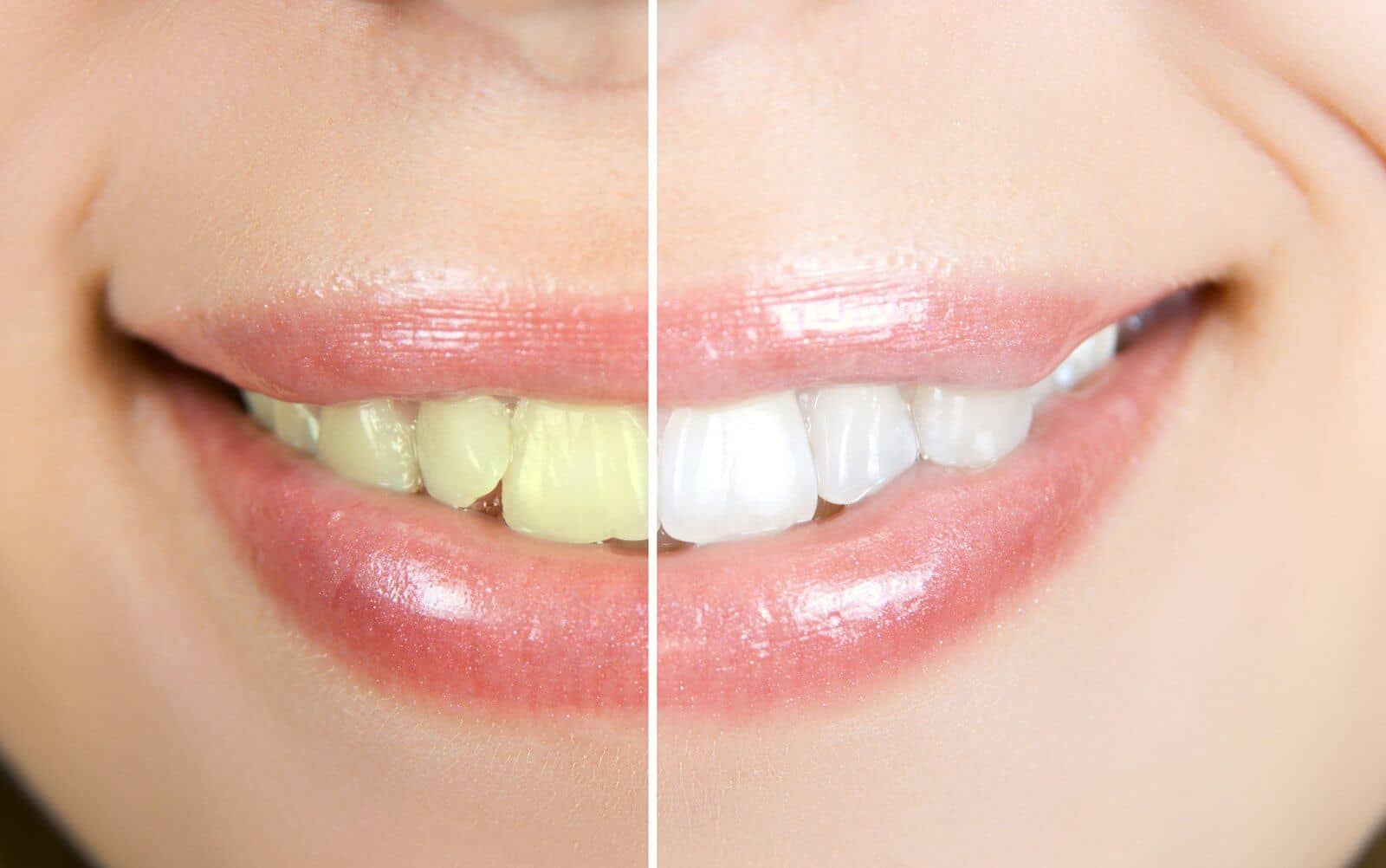 Teeth not white after bleaching