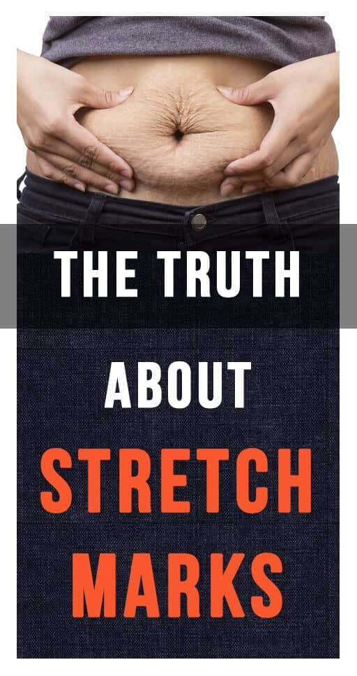 The Truth About Stretch Marks: What You Really Need To Know About Them