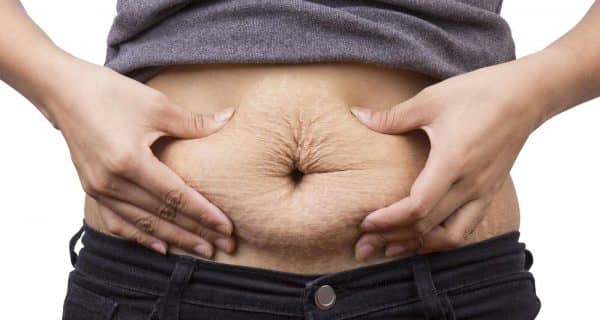 Stretch Marks