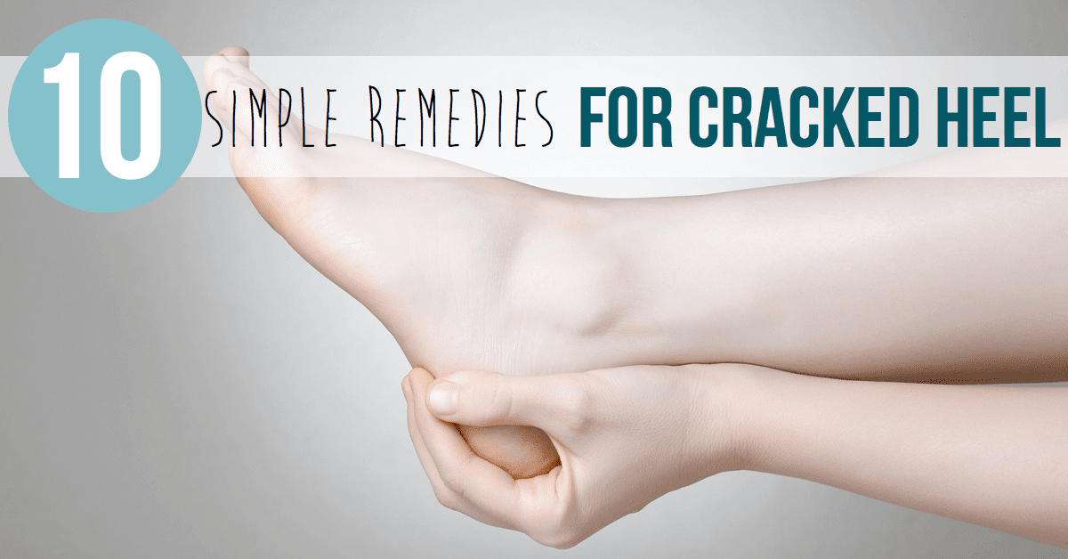 Top 10 Home Remedies for Cracked Heels | Tips for Natural Beauty