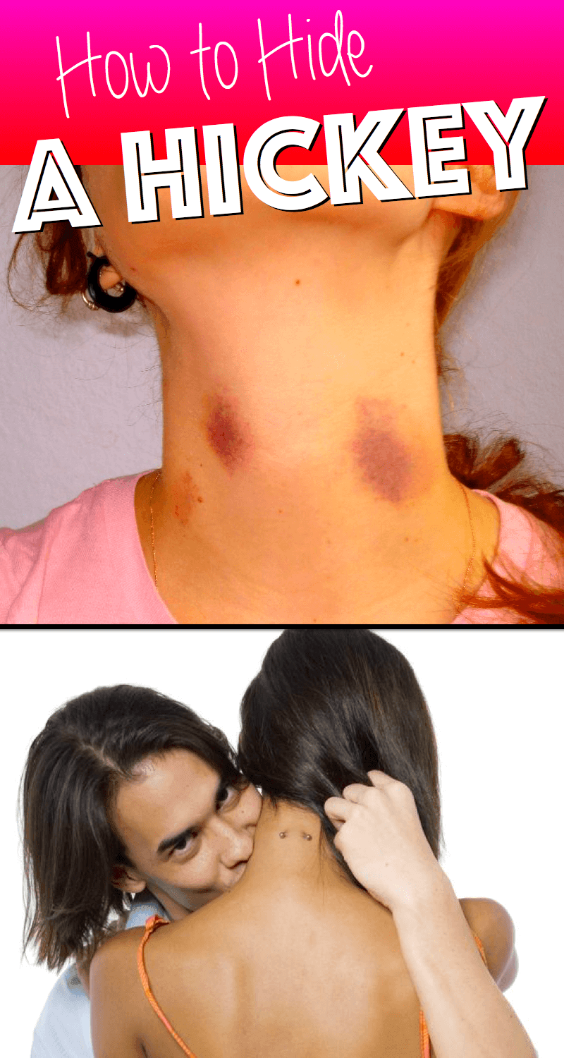 How to get rid of deals hickies as soon as possible